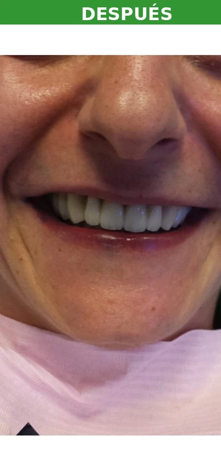 Resultado implante dental Aluche — después